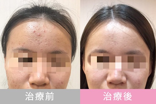 中醫微針治療痘痘