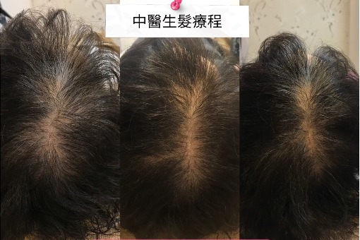 掉髮治療案例分享